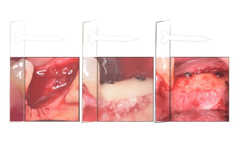 Técnica de Placas Ósseas